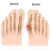 Image of Bunion Corrector Splint
